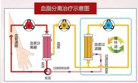 血脂分离治疗疗法——脂肪肝/肝代谢异常净化治疗